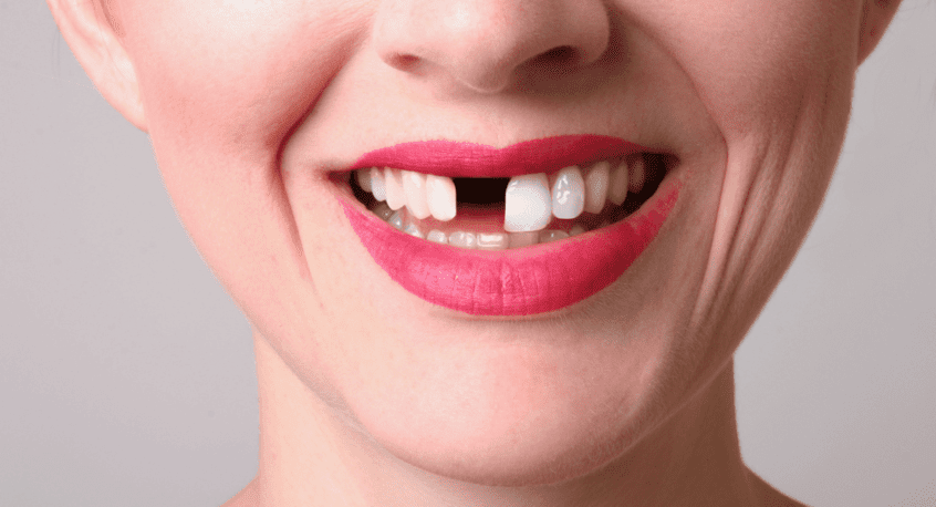 Implantati ili zubni most?